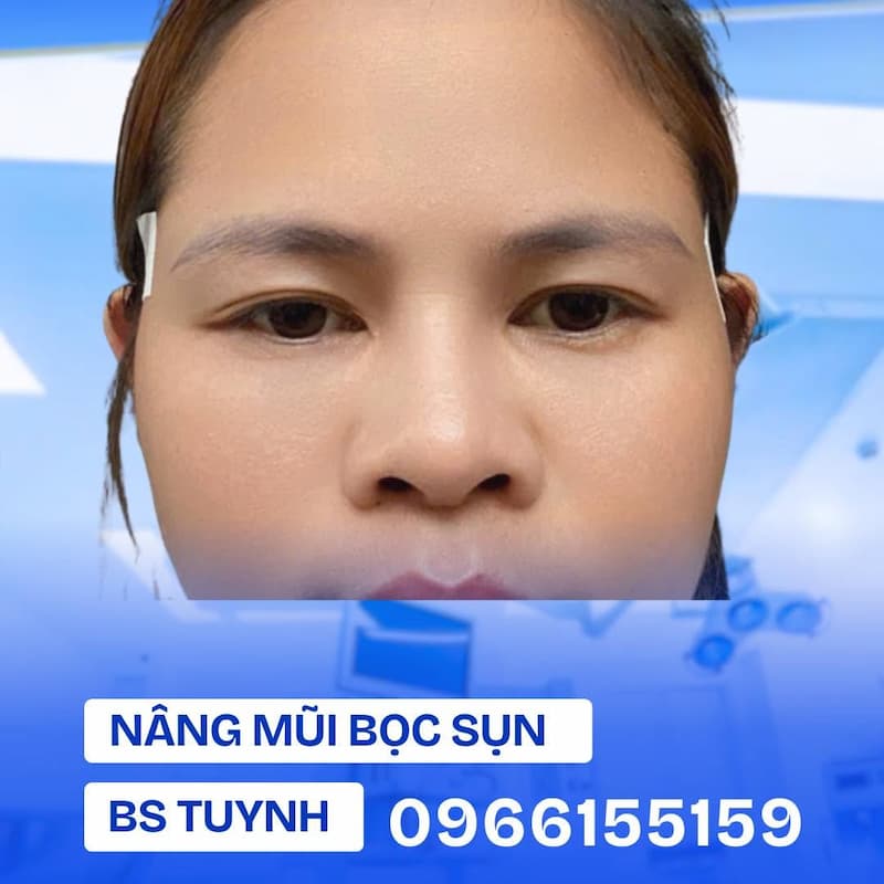 nang mui bon sun bac si tuynh (1)