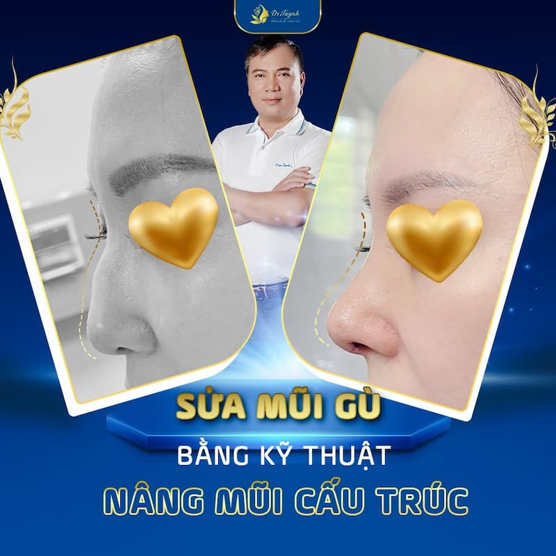 sua mui gu dr tuynh (1)