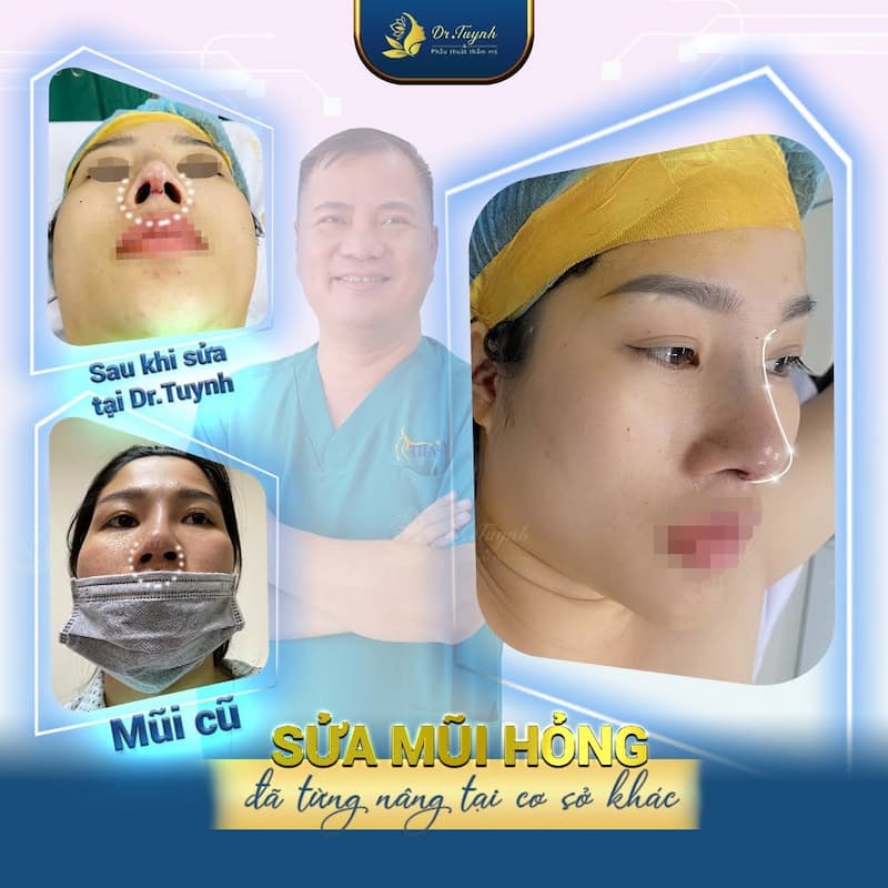 sua mui hong dr tuynh (1)