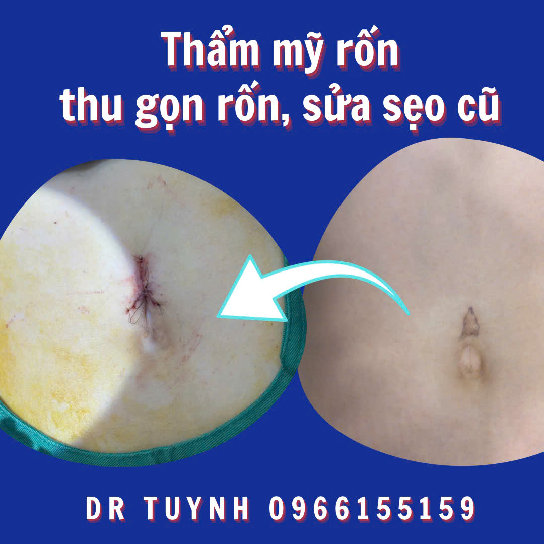 sua-seo-ron
