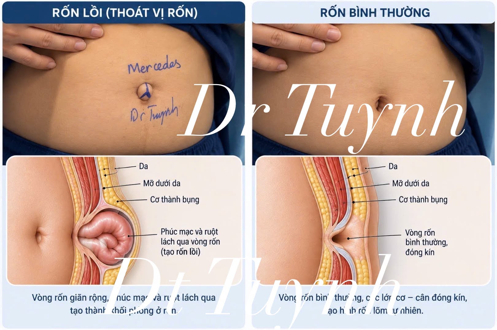 Thoát vị rốn và thẩm mỹ rốn so sánh phân biệt cách điều trị