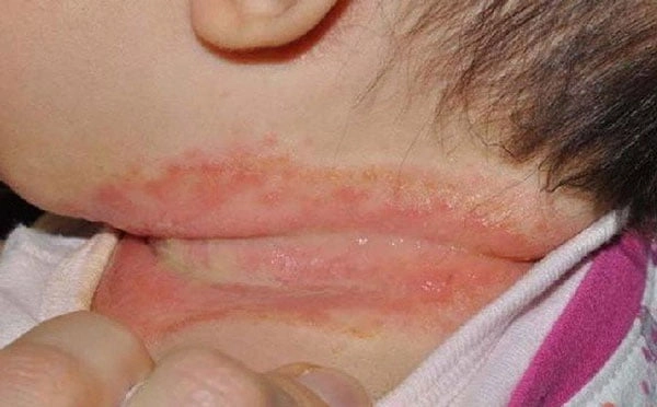 be-bi-rom-ray-vao-mua-he