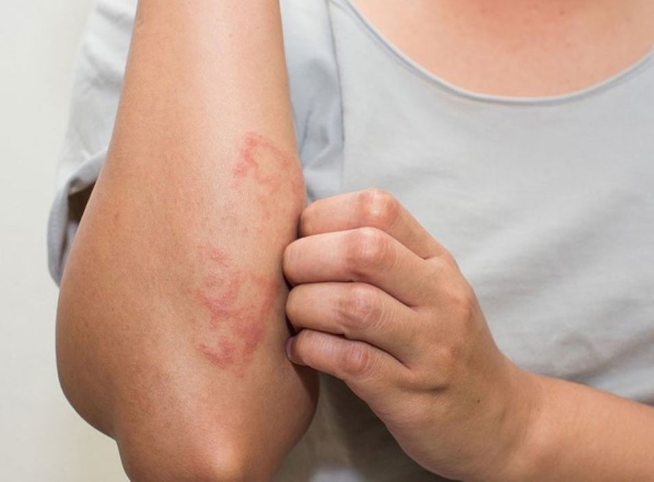 Chuyên gia giải đáp: 3+ Nguyên nhân uống nước kiềm bị ngứa