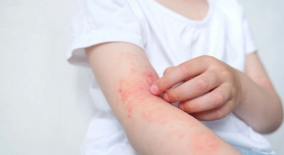 Dị ứng da là một trong những ảnh hưởng phổ biến khi dùng nước nhiễm kim loại