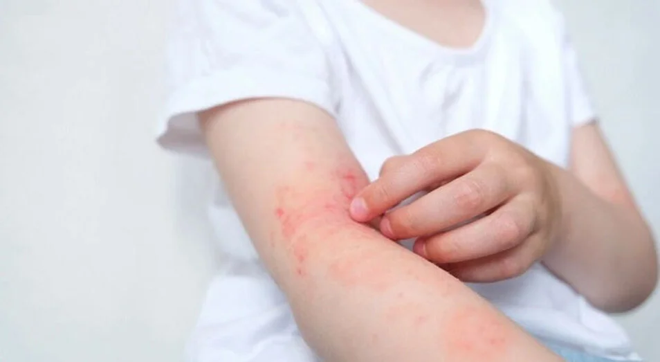 Dị ứng da là một trong những ảnh hưởng phổ biến khi dùng nước nhiễm kim loại