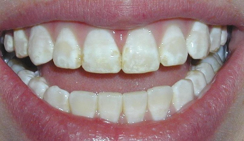 歯のエナメル質の損傷は、歯痛、虫歯、知覚過敏などのさまざまな病気を引き起こす可能性があります。