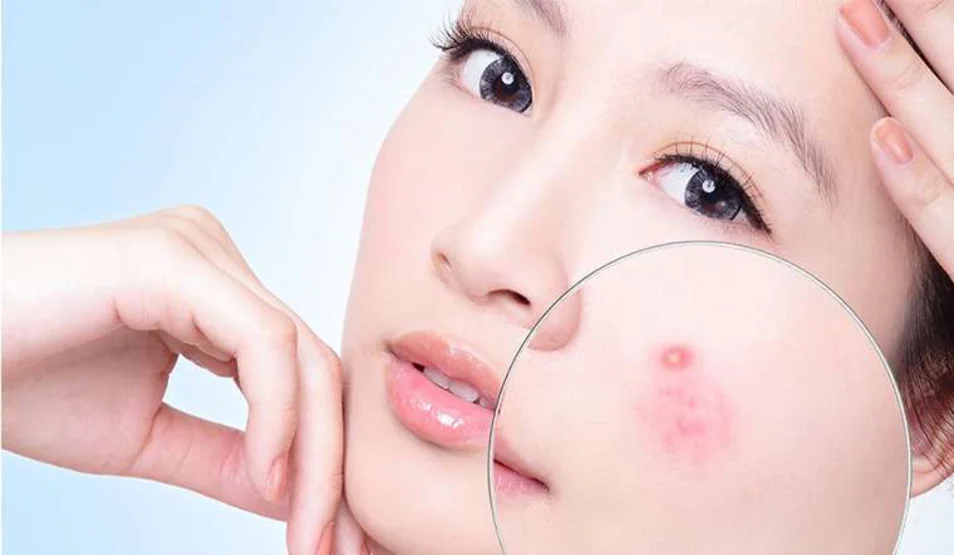 ngan-ngua-mun-trung-ca