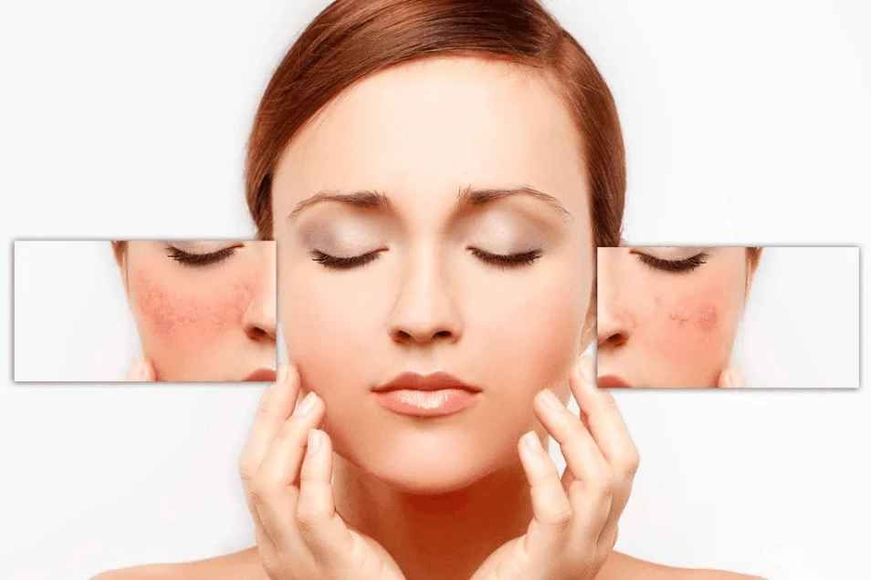 Using salty mineral water helps soothe the skin and is anti-inflammatory and antibacterial.