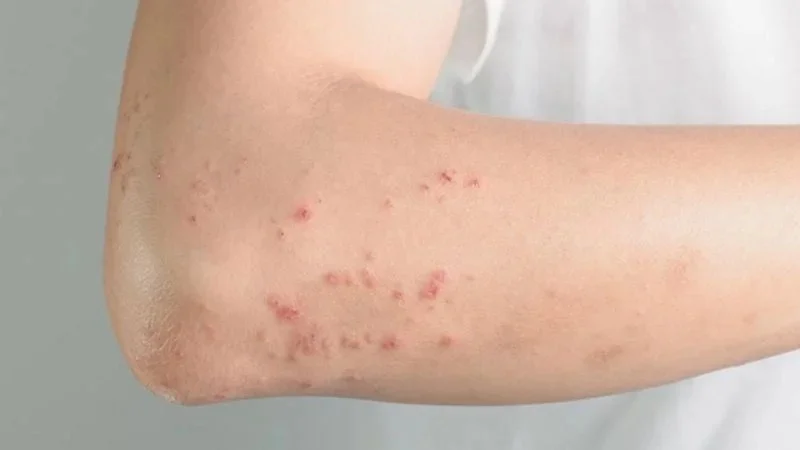 Using iron-contaminated water to clean your body every day causes skin damage.