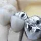 Bọc Răng Inox