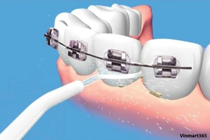 Máy tăm nước cao cấp phù hợp cho người niềng răng