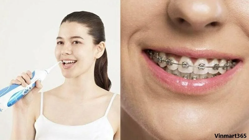Top 5 Máy Tăm Nước Cho Người Niềng Răng Được Nha Sĩ Khuyên Dùng