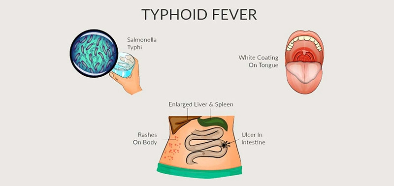 Typhoid fever
